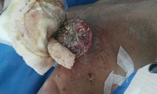 痛风病人饮食不正确,痛风患者营养失调的护理措施