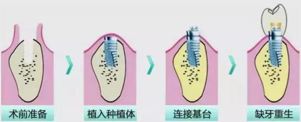 种植牙种植失败可以要求退款吗,种植牙失败了哪里投诉
