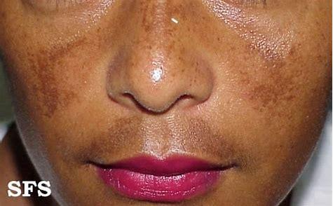 褐斑雀斑老年斑,老年斑褐斑晒斑图片