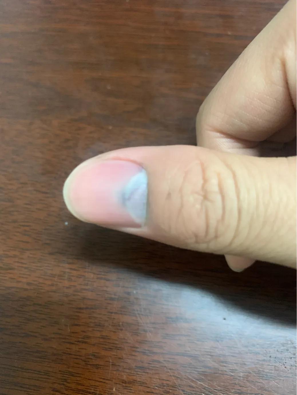 手指被夹出淤血该怎么办,手指被门夹淤血疼到睡不着