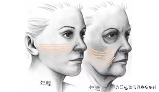 面部凹陷填充哪种方法最好,面部凹陷填充的方法有哪些