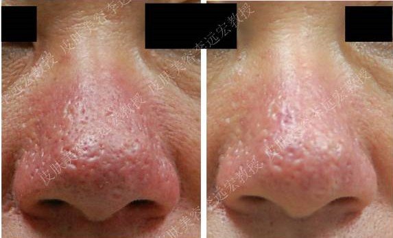 酒渣鼻有什么特效药,酒渣鼻的原因及治疗