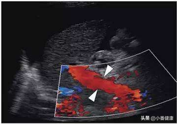 乙肝大三阳12点睡觉算熬夜吗,乙肝大三阳熬夜引起轻度纤维化