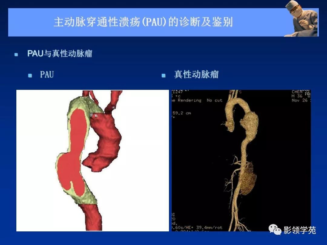 主动脉夹层壁间血肿如何鉴别,主动脉夹层血肿溃疡
