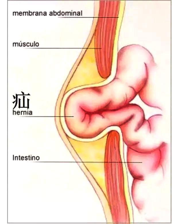 一个小手术的感受,腹股沟疝怎么缓解疼痛