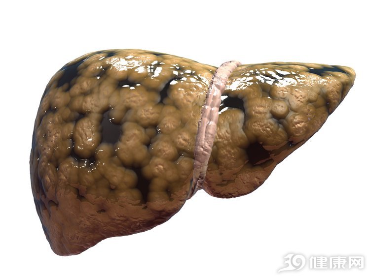 重视：肝会硬化，多是几个原因惹的祸，请重视