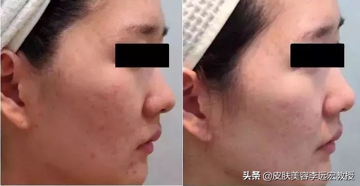 婴儿针是微针还是水光,bb针和水光针的区别