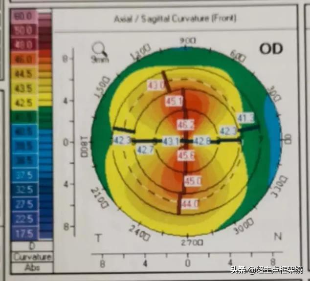 孩子眼睛近视加散光如何治疗,儿童视力散光180度怎么办