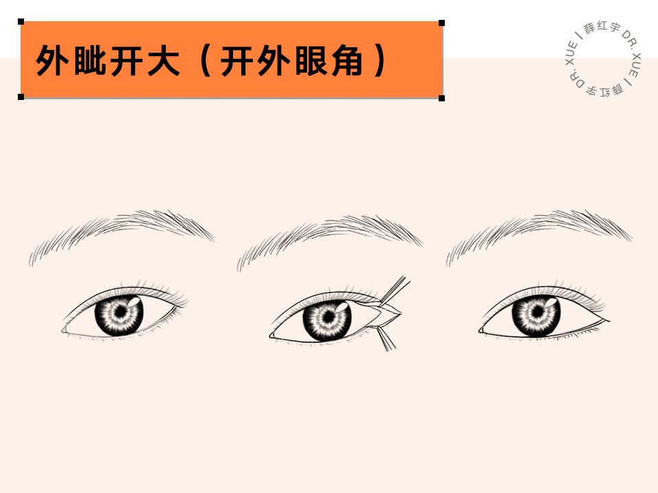 要不要开下眼睑,要不要开内眦赘皮