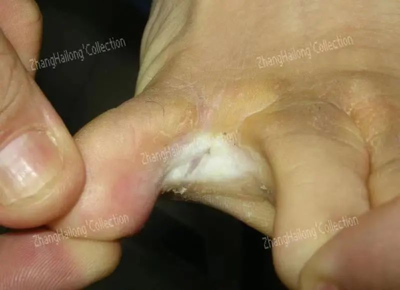 足癣和丹毒的区别,足癣和脚气一样吗