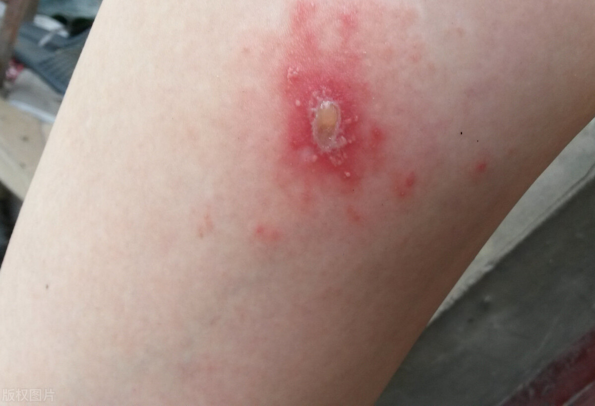 夏季虫咬皮炎怎么解决,夏季皮肤病攻略虫咬感染篇