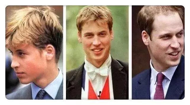 脱发真的很影响颜值么,脱发除了遗传还有什么原因