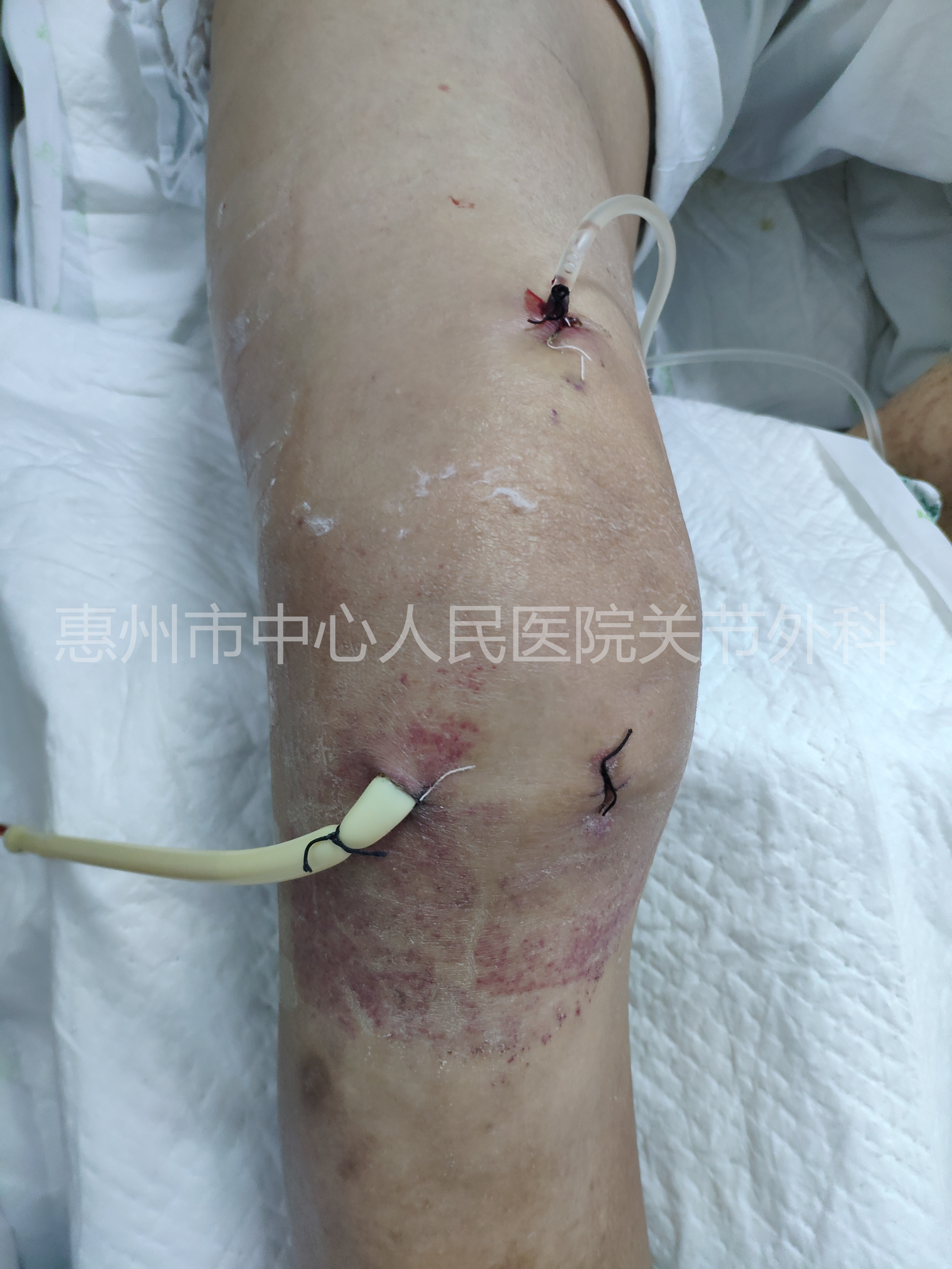 关节炎的病理知识,关节炎科普视频