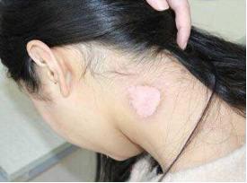 女孩突然发现自己白癜风,突然发现得了白癜风