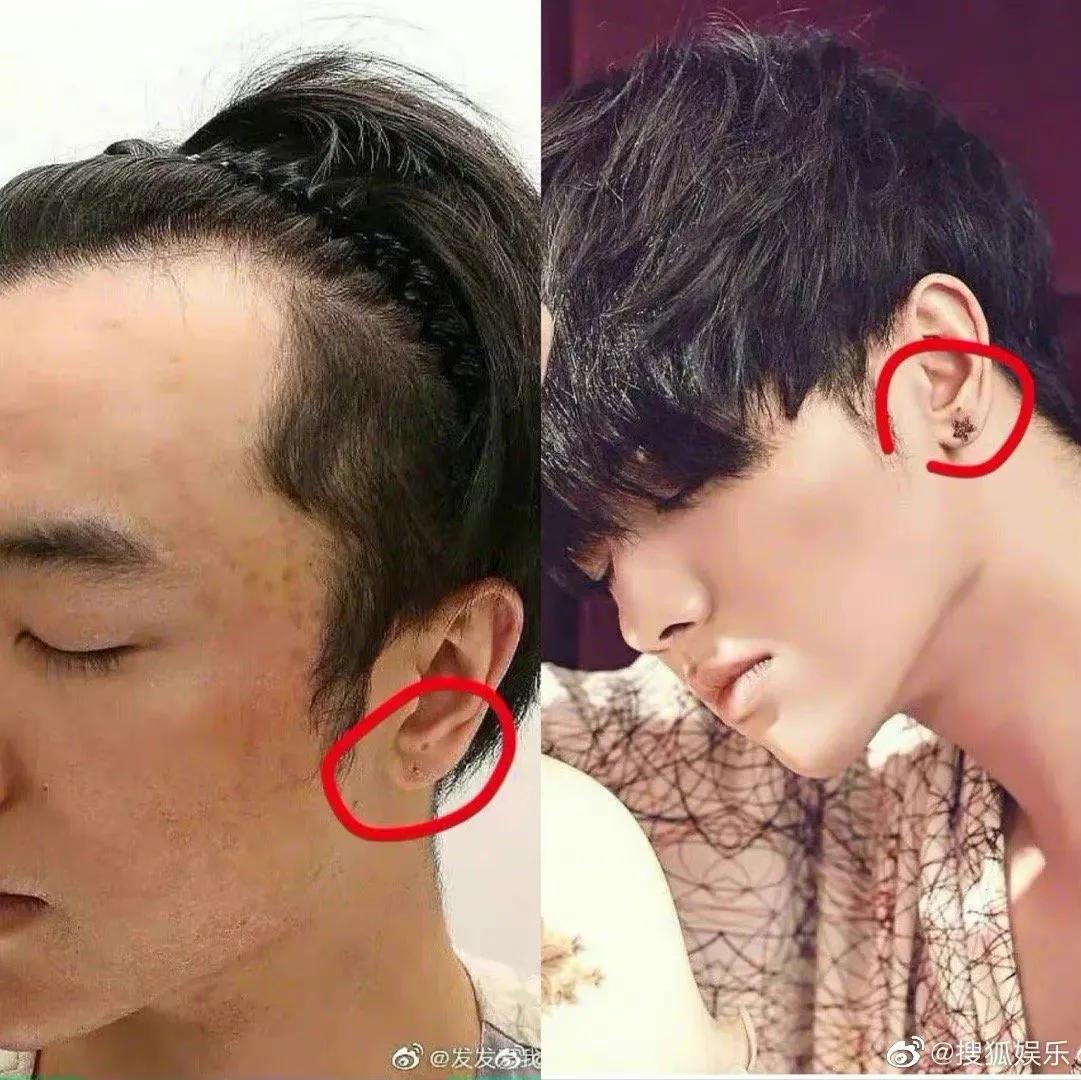 华晨宇在哪植发的,华晨宇是否植发
