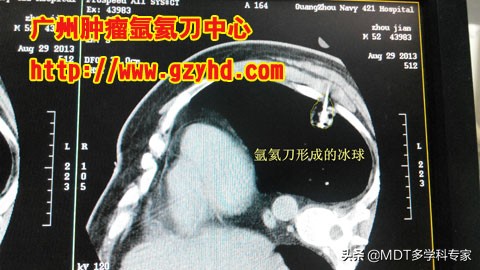 肺癌可以做微波消融术,肺结节肺癌可以吃中药调理吗