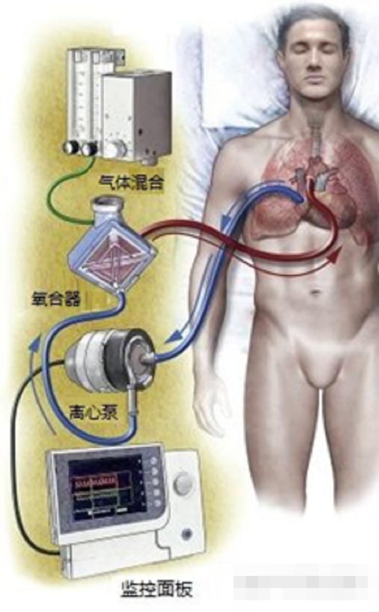 中国呼吸机国外供不应求,中国呼吸机现状