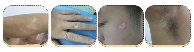 身上起小白点是什么原因怎么治,身上有一块白斑汗毛也是白的