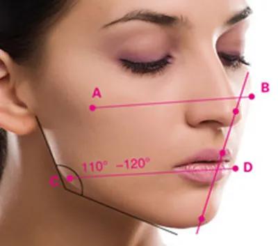 高角型下颌后缩什么样子,高下颌角后缩怎么矫治