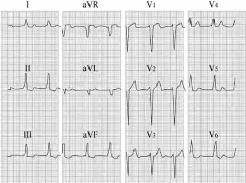 心律失常55分钟讲解,心律失常心电图讲解视频教程全集