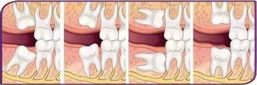 最简单的智齿拔除多少钱一颗,拔除智齿一般多少钱一颗