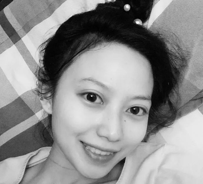 龅牙矫正前后对比照片,龅牙修复效果图