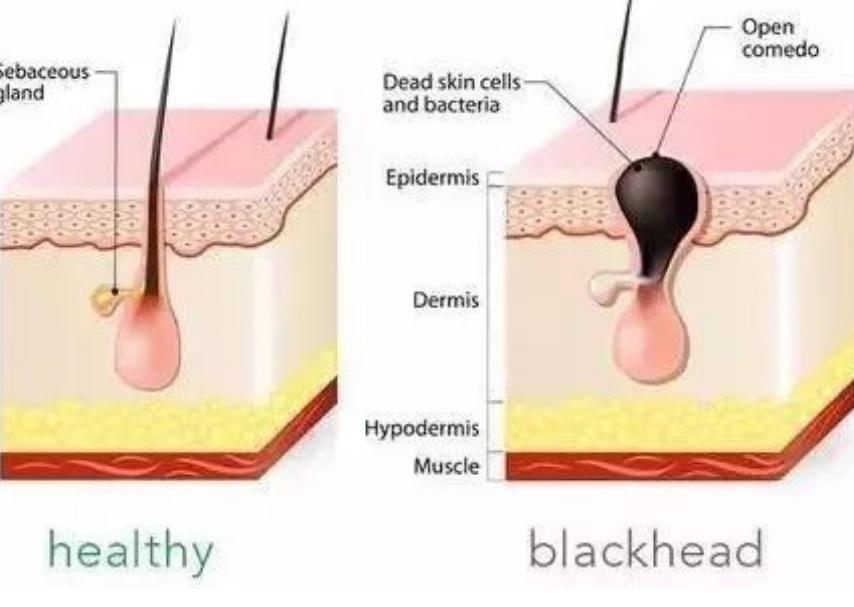 黑头如何能挤彻底,挤后背黑头起了大硬包怎么办