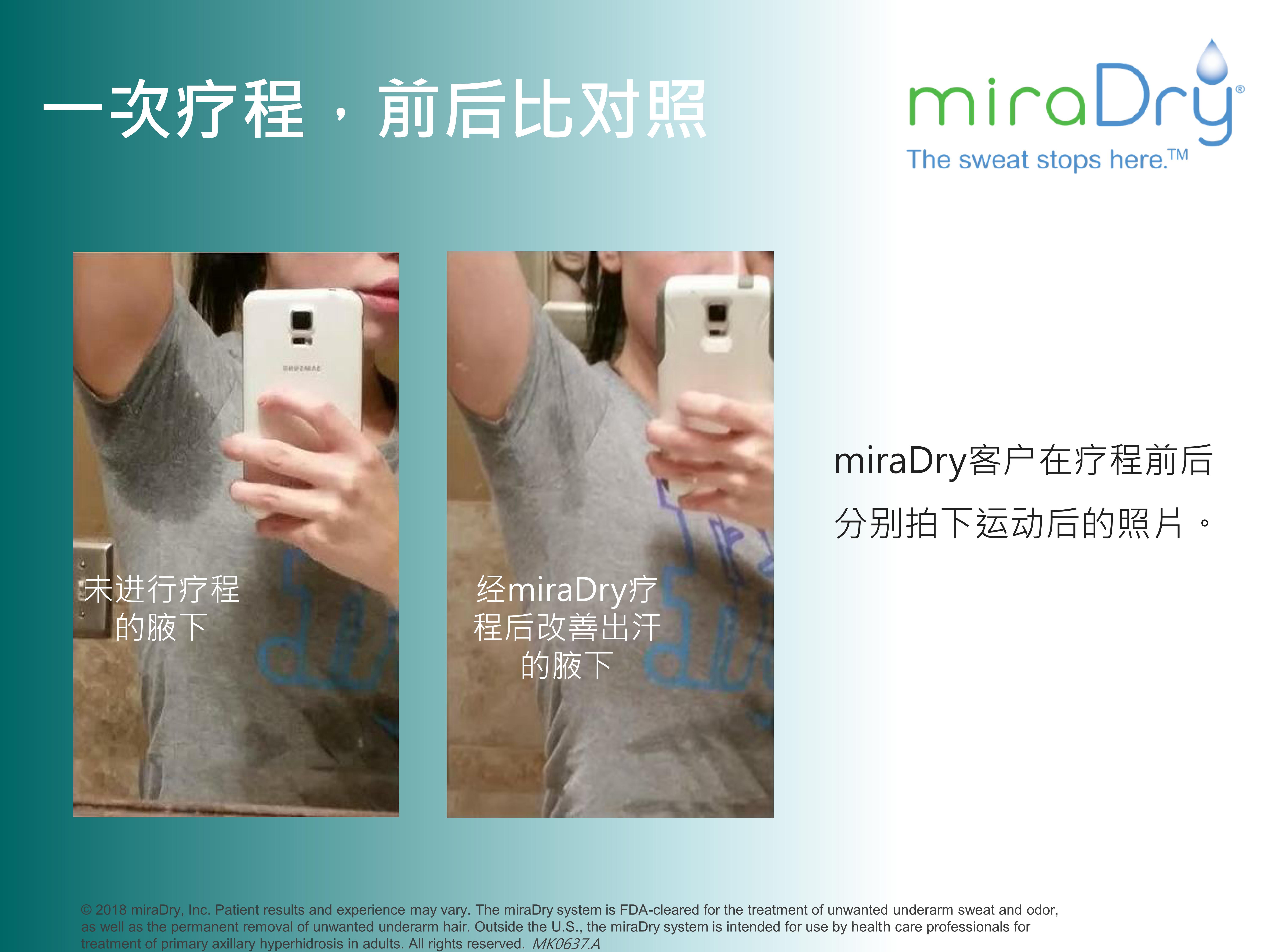 miradry微波治疗腋臭会复发吗,miradry和黄金微针哪个治疗腋臭好