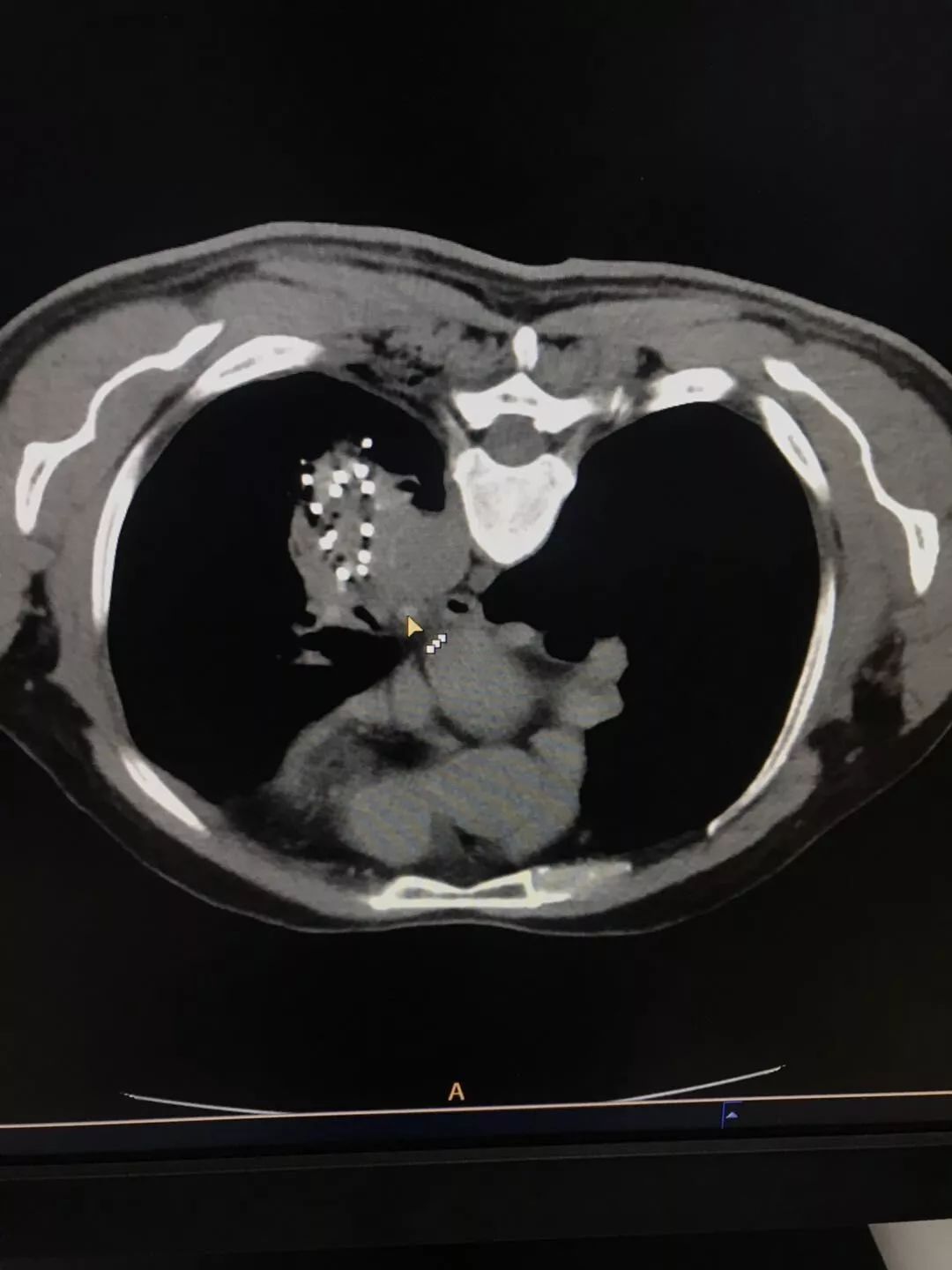 晚期肺癌患者，应用粒子植入术，抗癌案例分享