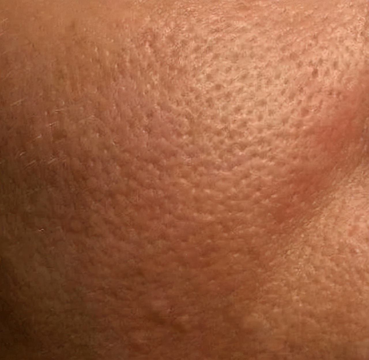 40岁以后毛孔明显了,40岁女人脸上毛孔大怎么办