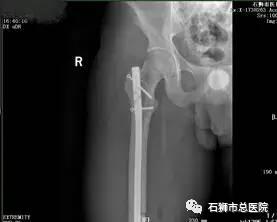 石狮市骨科医院,石狮市总医院骨科多少钱