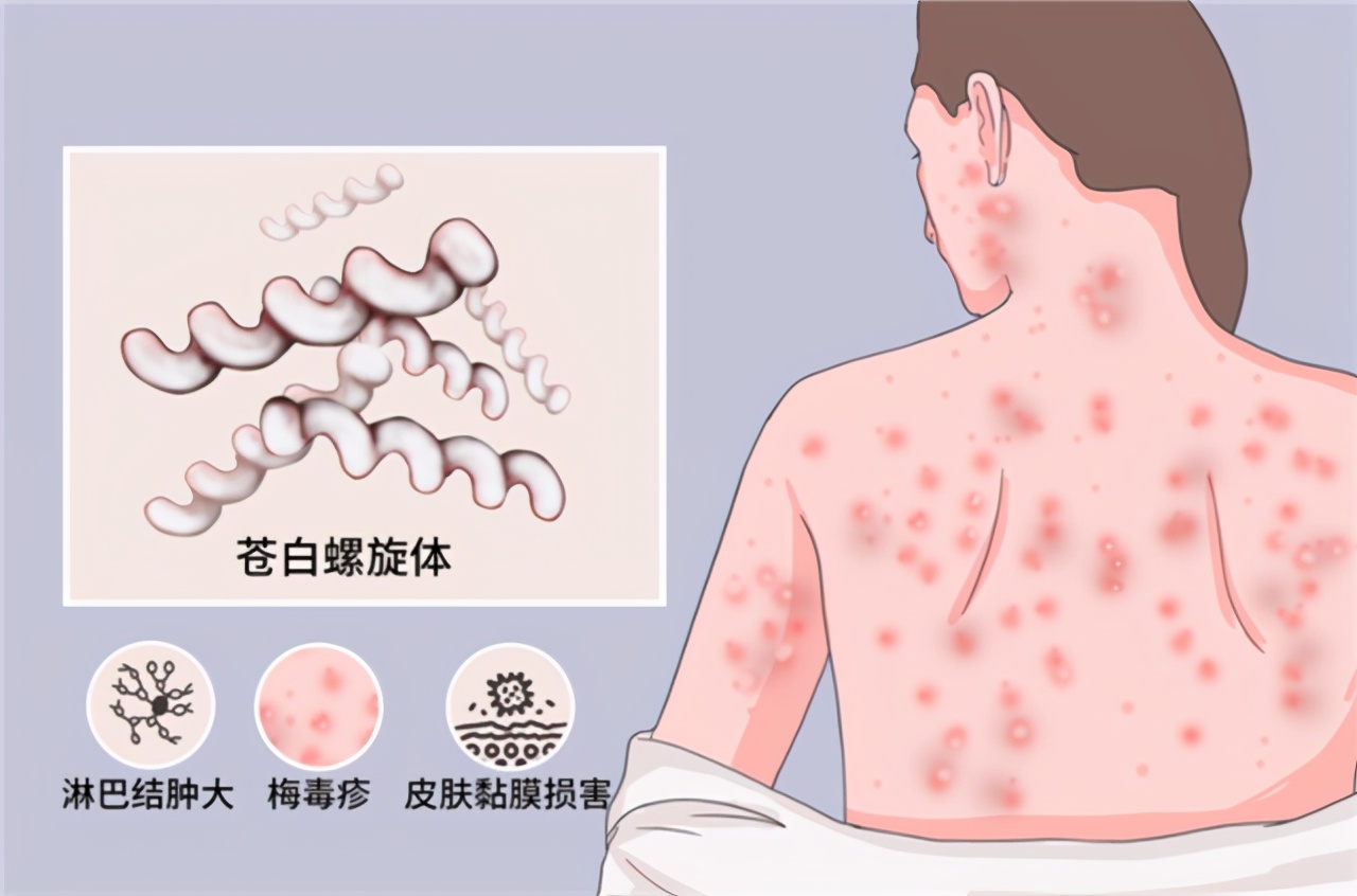 得了梅毒好得快牢记这5点,梅毒致死率多少