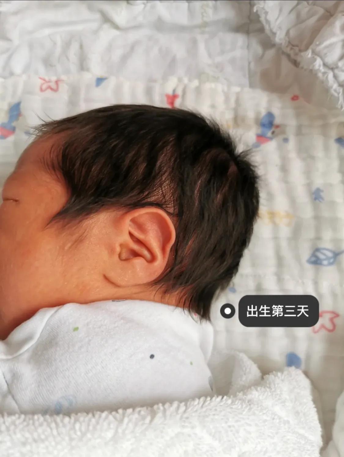 宝宝刚出生耳廓畸形，现在长成什么样了？