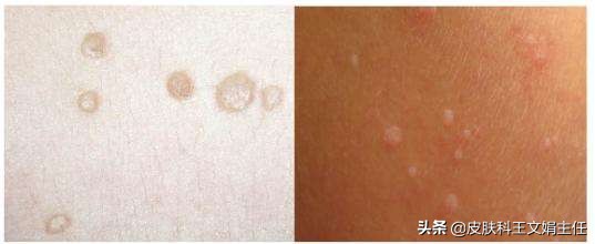 关于扁平疣的治疗,皮肤扁平疣能彻底根治吗