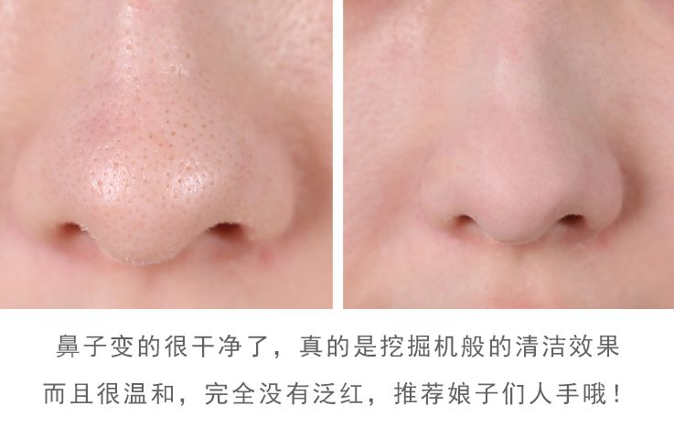 黑头闭口连根拔起,黑头粉刺连根拔起留坑