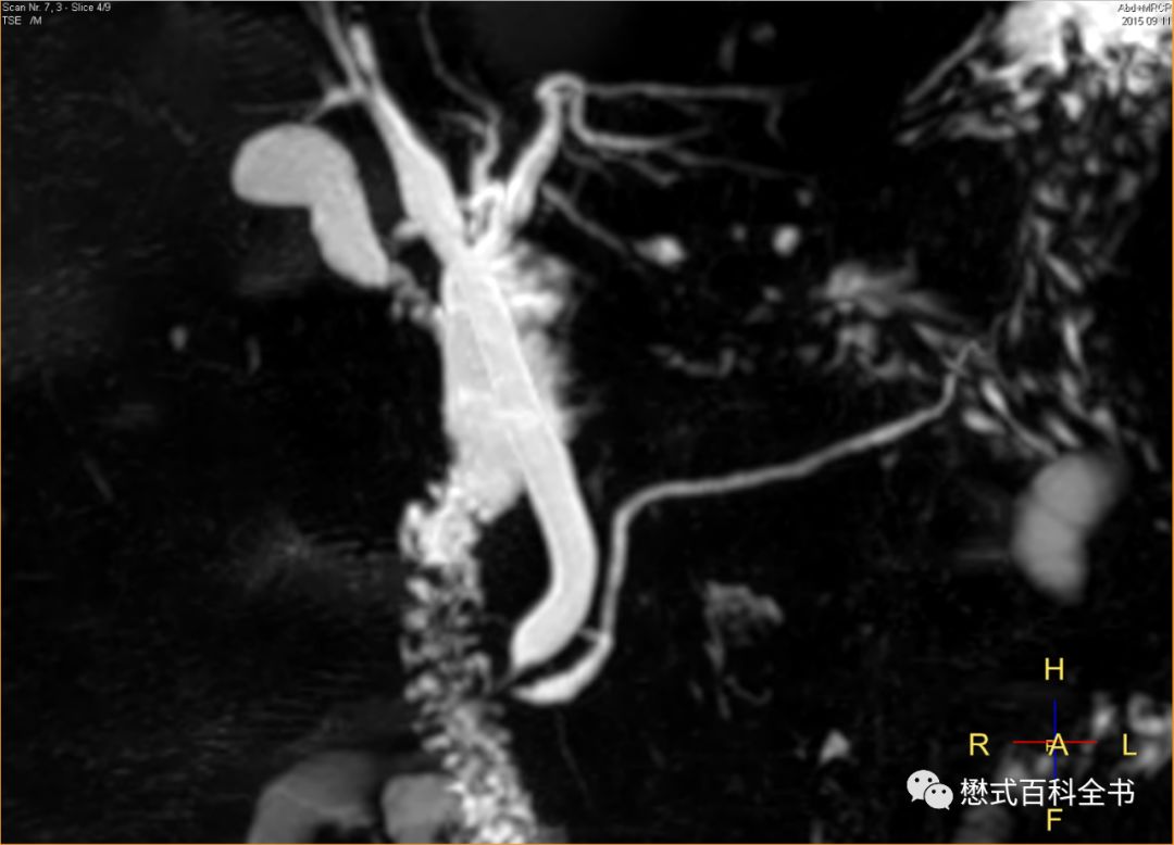 开展mrcp技术,mrcp检查操作流程