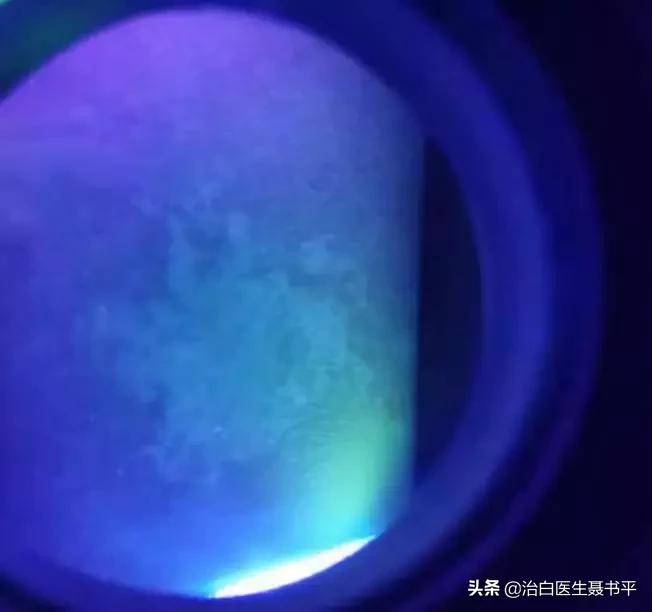 医生无法确定无色素痣还是白癜风,无色素痣误诊白癜风