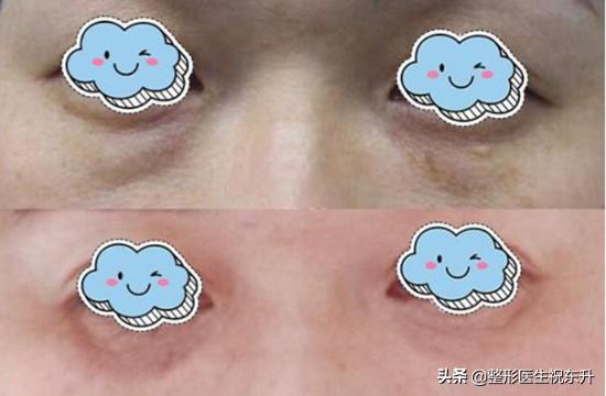 祛眼袋术后脸肿得很厉害怎么办,祛眼袋术后多久可以做皮秒