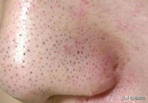 比痘痘更烦人的闭口来了,最有效的去闭口*法大**看过来