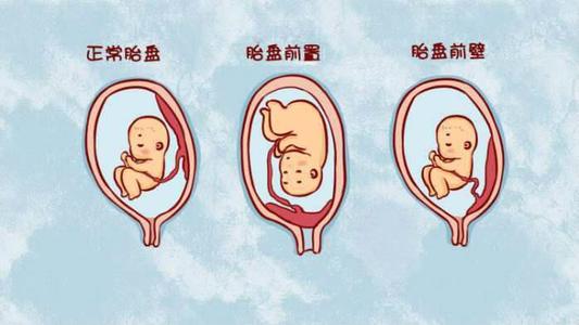 胎盘低怎么养胎,后壁胎盘出现了胎盘低置怎么办
