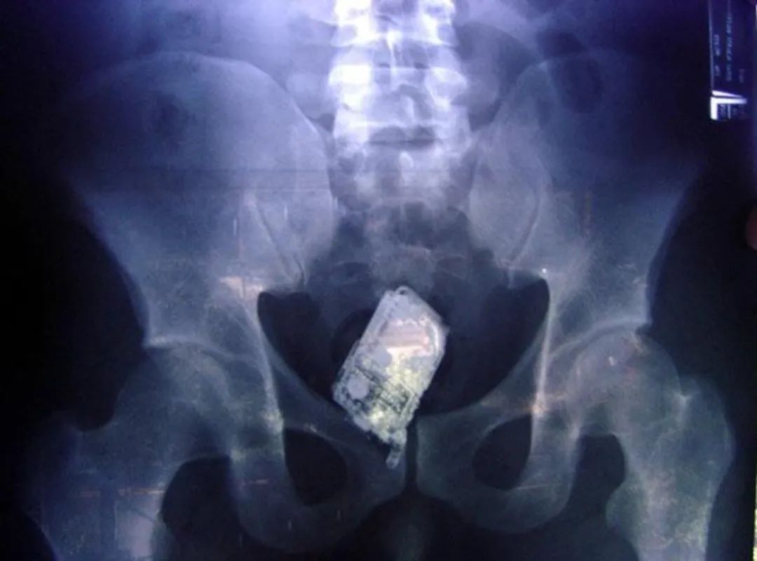 医生们曾在人体内取出过多少神奇的物件?