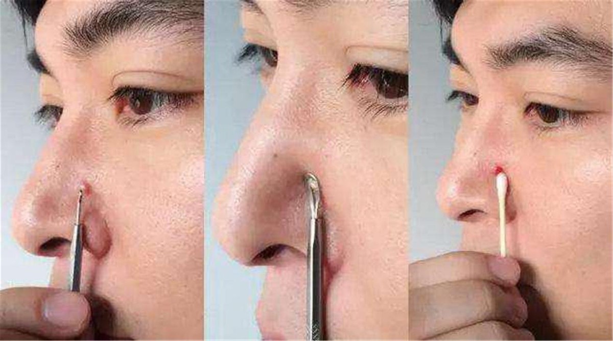 “危险三角区”的痘痘千万不能挤！有人挤了一下，结果留下后遗症