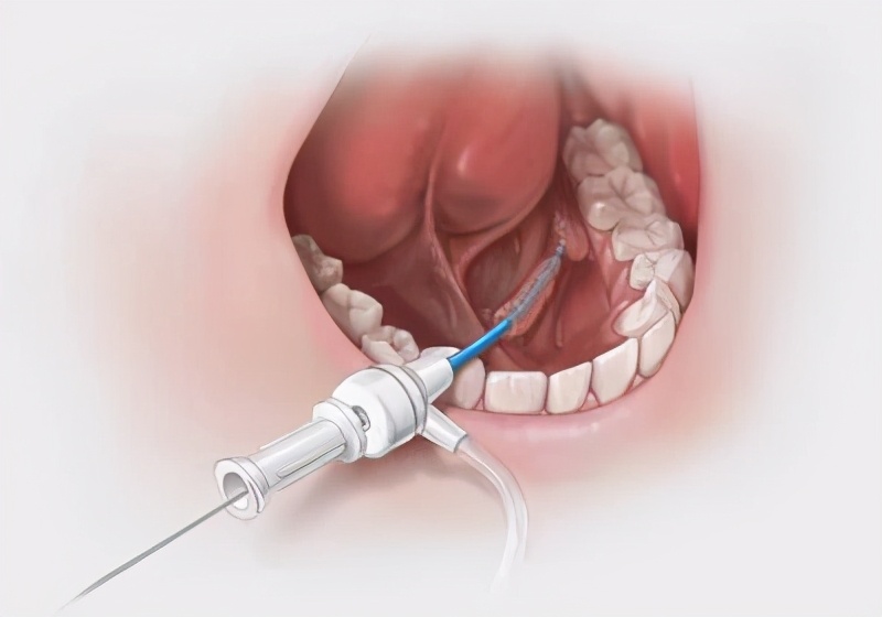 36岁女子一吃饭下巴就痛，这是什么怪病？医生：嘴巴里有个石头