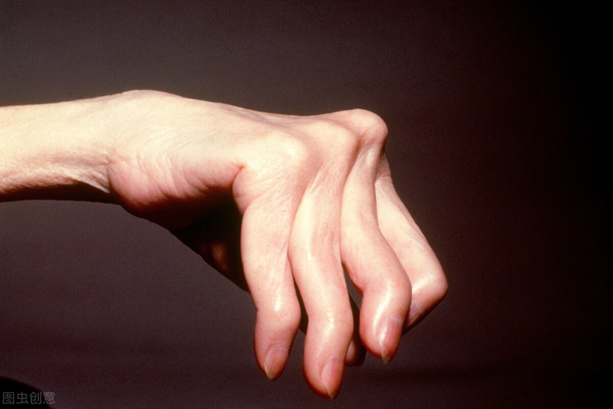 类风湿性手指肿如何消肿,类风湿手指肿了外敷药