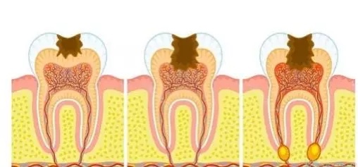 牙痛怎么缓解有妙招,牙痛怎么快速解决小妙招