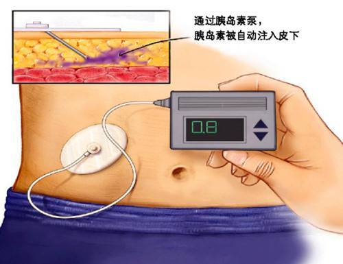 胰岛素泵科普；降伏糖魔的绝招是什么？这4点好处让糖友又爱又恨
