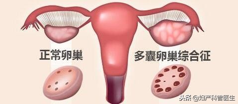 身上多毛一定是多囊卵巢综合征吗,多毛痤疮月经不调就是多囊卵巢吗