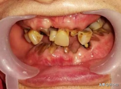 牙龈出血口臭跟牙齿不贴合,有个牙齿晃动牙龈出血口臭
