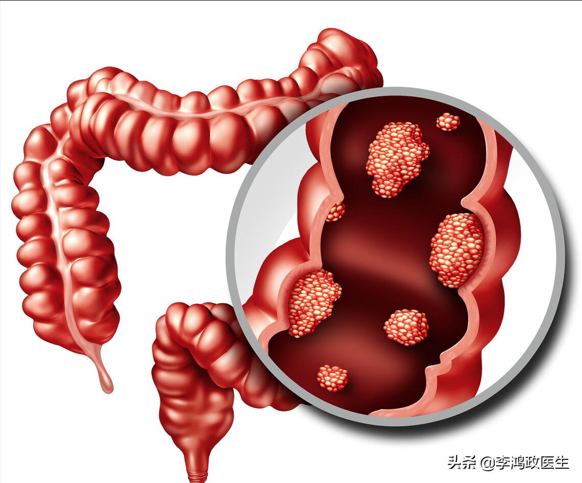 男子屁股痒,肛门瘙痒痔疮需要做肠镜吗
