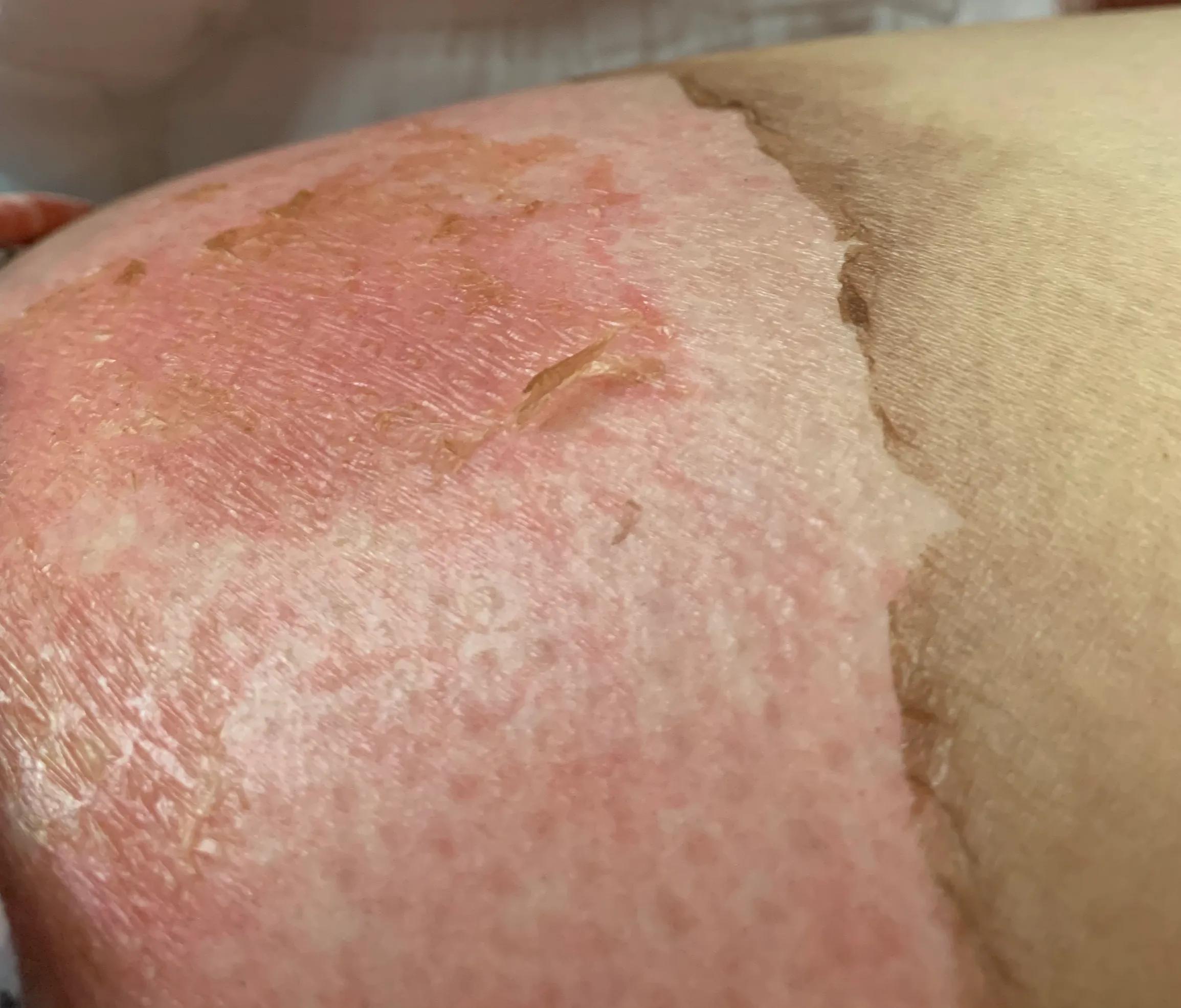 浅二度烫伤14天恢复图片,宝宝浅二度烫伤多久能恢复正常